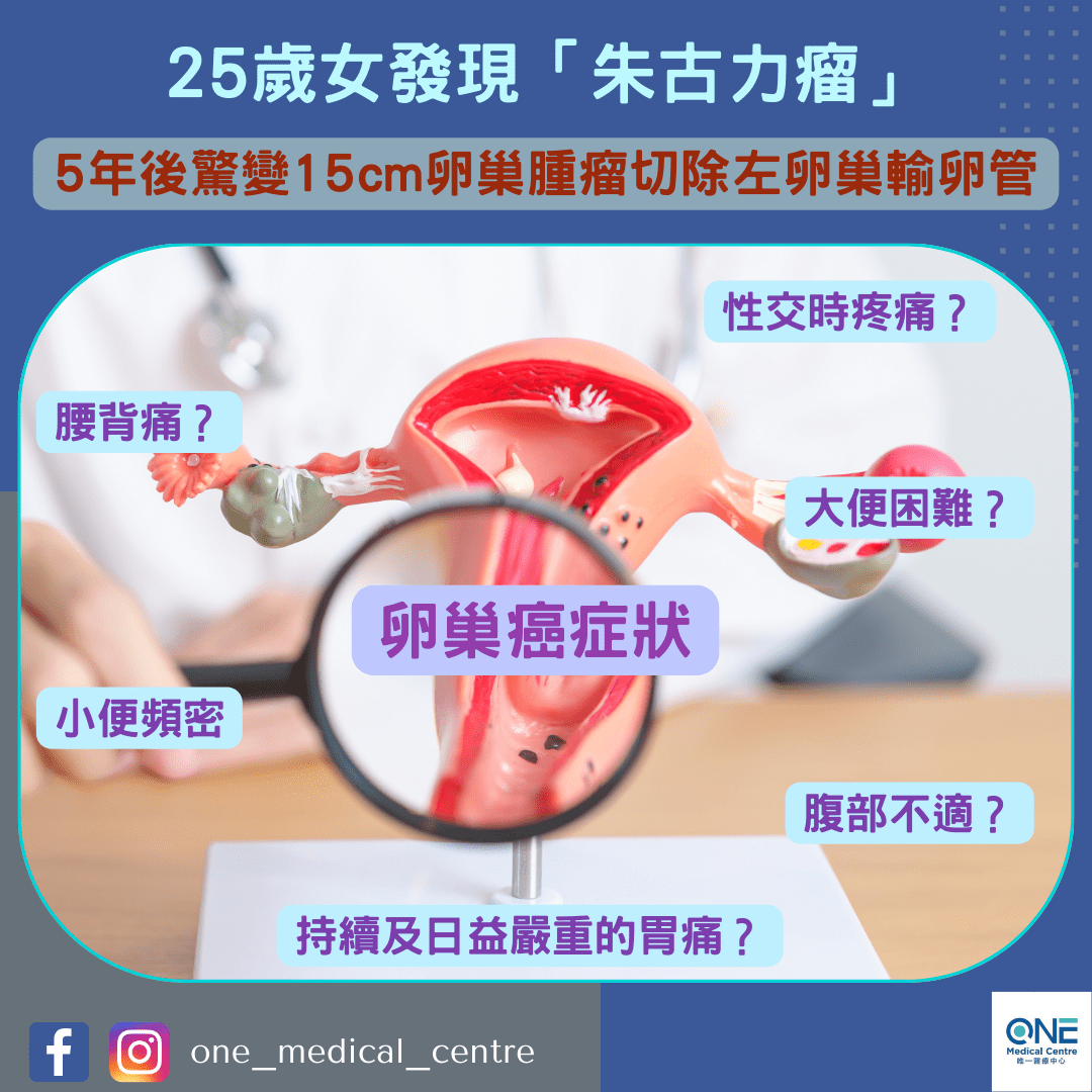 【卵巢癌︱25歲女發現「朱古力瘤」　5年後驚變15cm卵巢腫瘤切除左卵巢輸卵管】